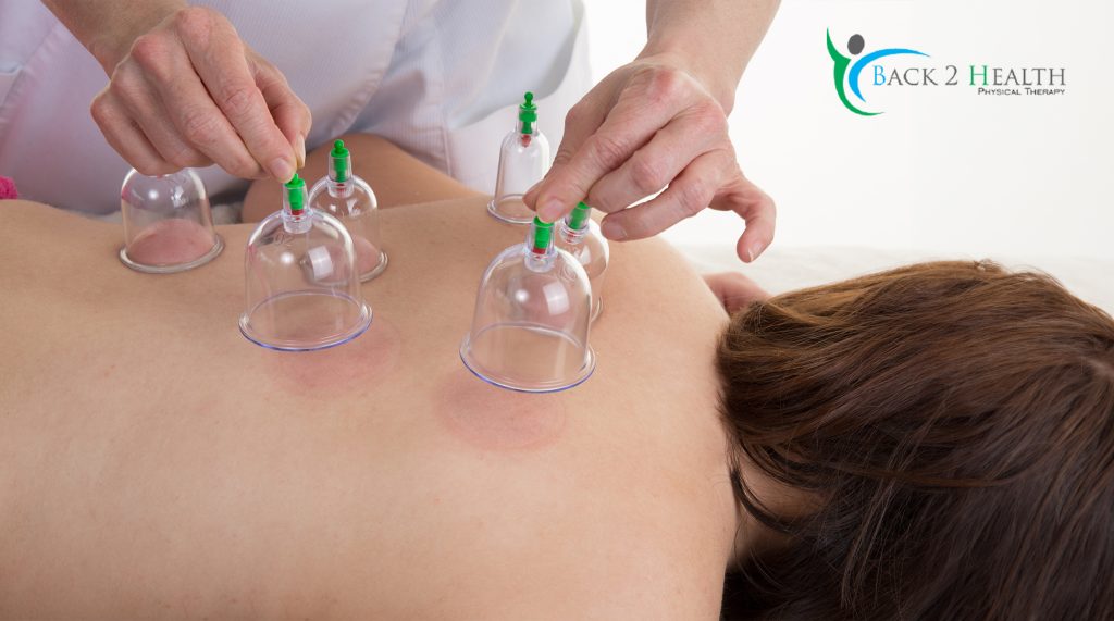 cupping treatment near you