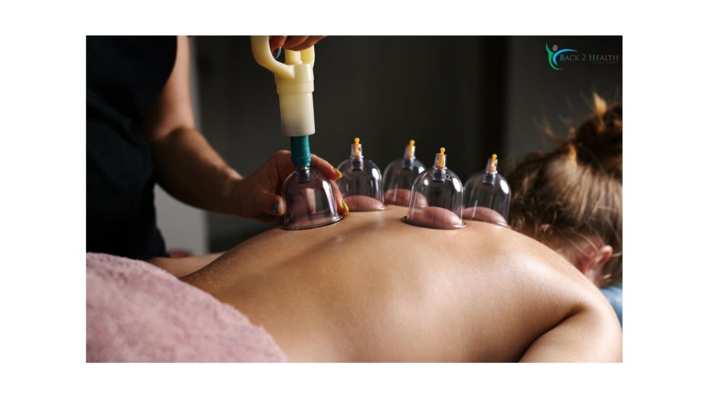 Cupping Therapy in Michigan