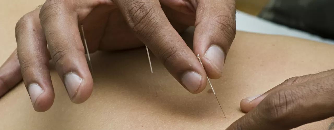 Dry Needling Sterling Heights, MI