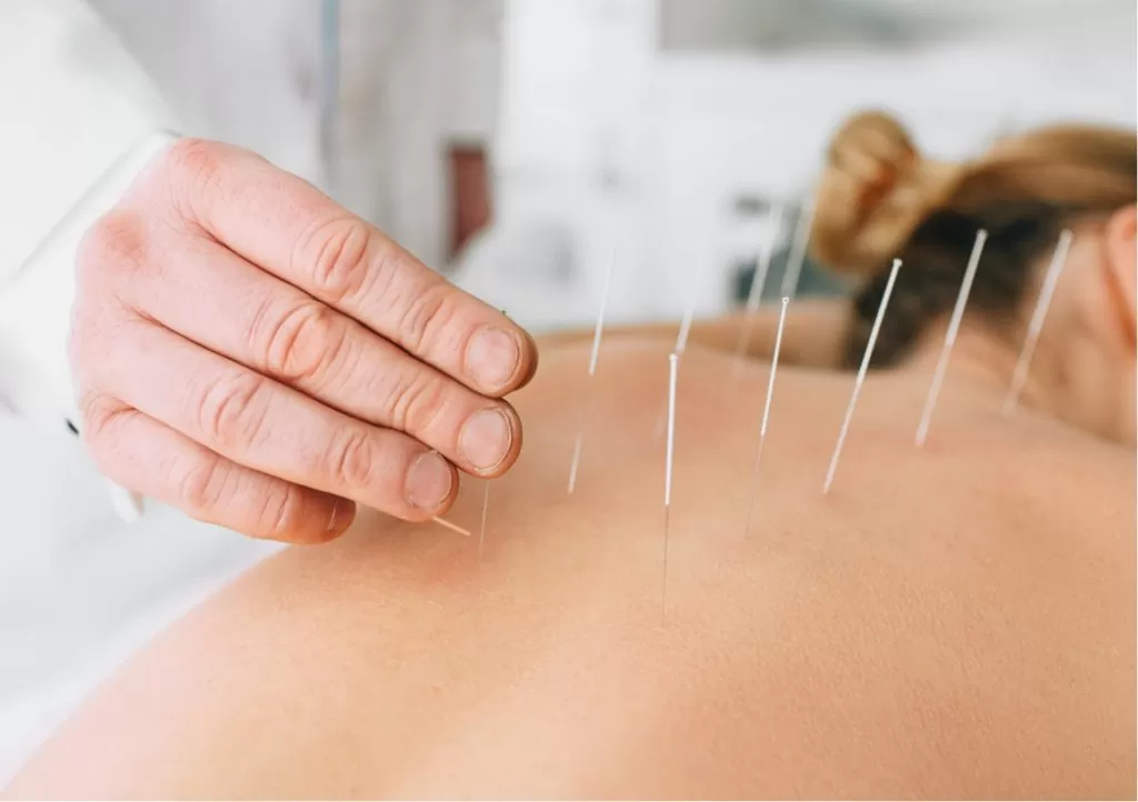 Dry-Needling experience