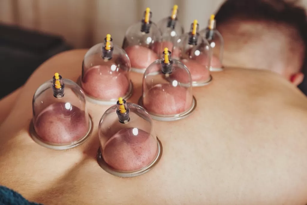 cupping therapy for pain relief michigan